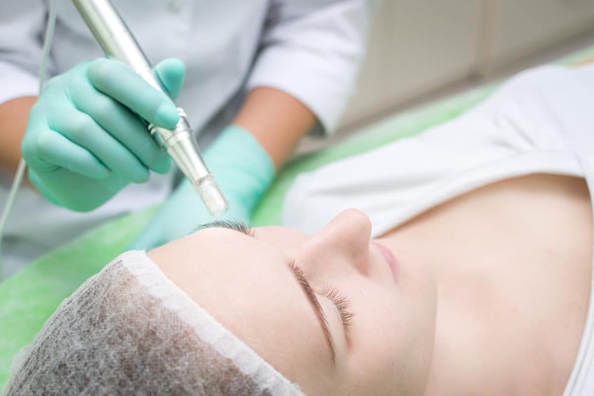 Microneedling & Pigmentation reduction Oakville